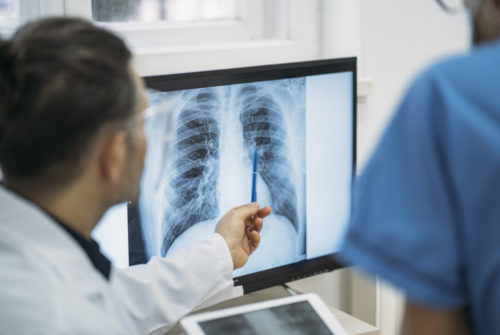 A mesothelioma doctor reviews a lung X-ray