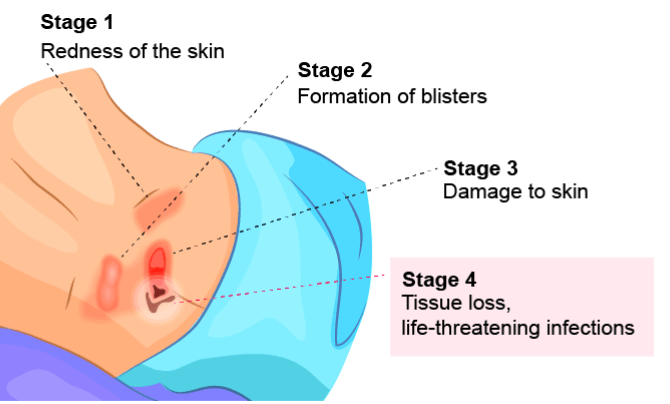 A stage 4 bedsore picture